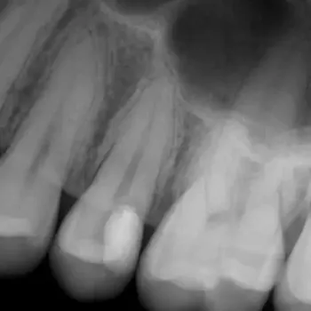 Behandlungsbeispiel für eine Pulpotomie