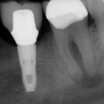 Endodontie Fall 4: großer interradikulärer Entzündungsherd