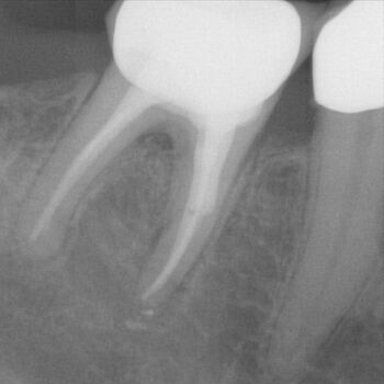 Röntgenbild: Instrumentenfragment Kontrolle nach Wurzelfüllung