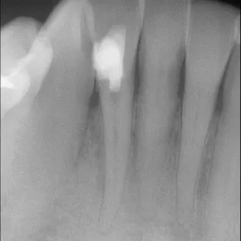 Endodontie Fall 6: Seitenkanal