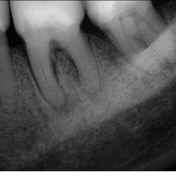DVT-Endodontologie-Fallbeispiele in der Zahnarztpraxis Dr. Buscot & Kollegen in Braunschweig