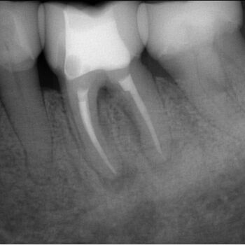 DVT-Endodontologie-Fallbeispiele in der Zahnarztpraxis Dr. Buscot & Kollegen in Braunschweig