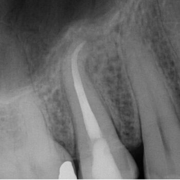 DVT-Endodontologie-Fallbeispiele in der Zahnarztpraxis Dr. Buscot & Kollegen in Braunschweig