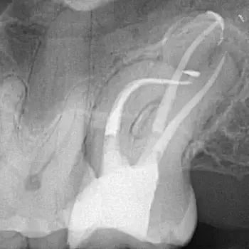 Endodontie Fall 5: Starke Wurzelkrümmung
