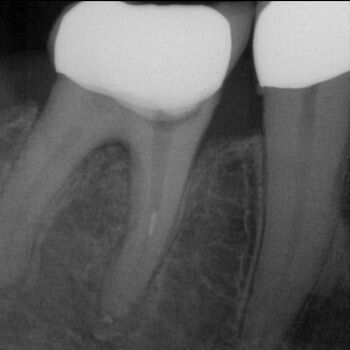 Röntgenbild: Instrumentenfragment Ausgangssituation