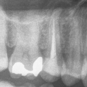 DVT-Endodontologie-Fallbeispiele in der Zahnarztpraxis Dr. Buscot & Kollegen in Braunschweig