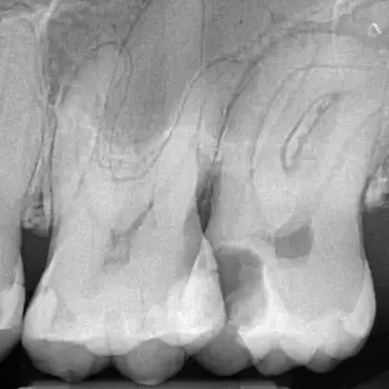 Endodontie Fall 5: Starke Wurzelkrümmung