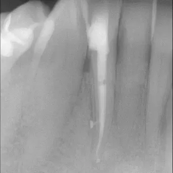 Endodontie Fall 6: Seitenkanal